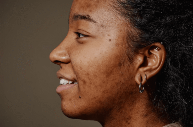 Dealing With Dark Spots? Here’s What Works